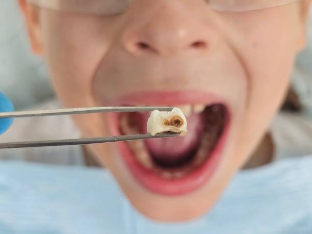 Best Emergency Dentist for Lost Fillings or Crowns in South Pittsburg, TN